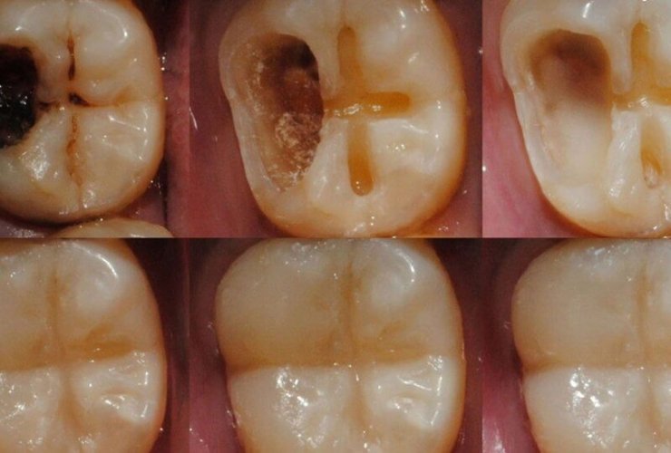 Gel That Can Regrow Tooth Enamel